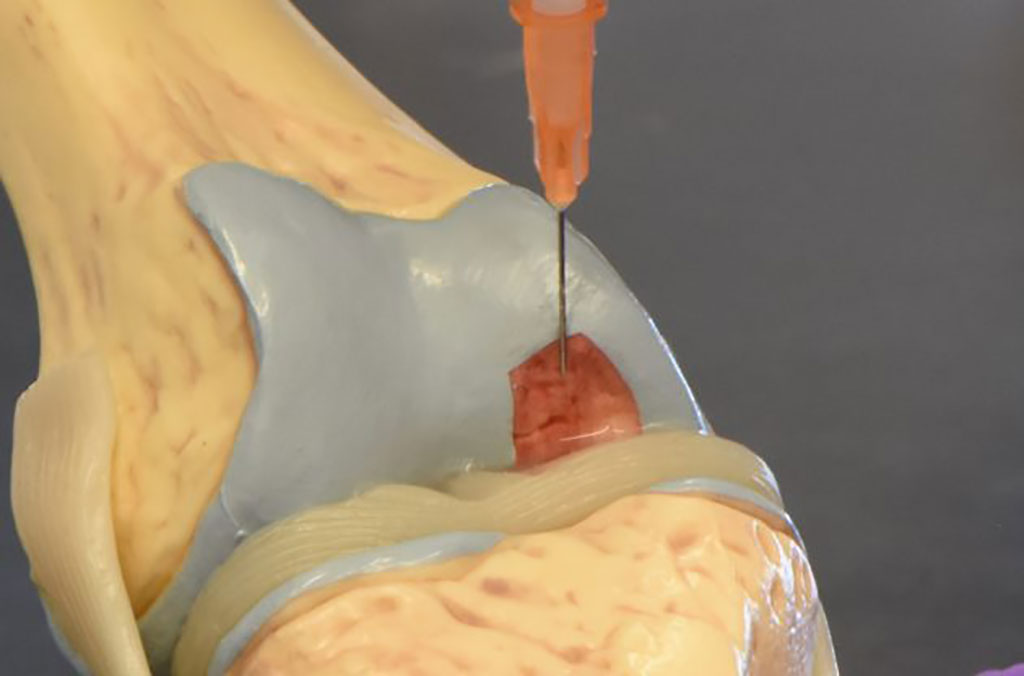 Image: A model of the researchers’ piezoelectric hydrogel being injected into injured knee cartilage (Photo courtesy of University of Connecticut)