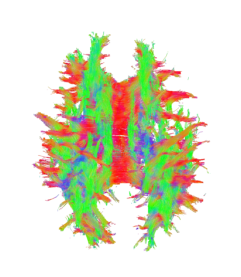 Image: A new algorithm called DeepSTI takes data from multiple individual scans and provides a `super-scan` of the brain (Photo courtesy of Johns Hopkins University) Image: A new algorithm called DeepSTI takes data from multiple individual scans and provides a `super-scan` of the brain (Photo courtesy of Johns Hopkins University)