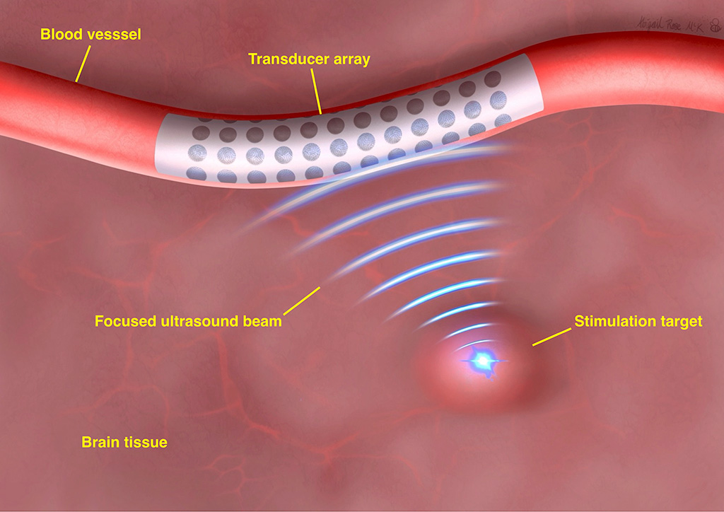 Image: Annotated illustration of brain tissue and proposed project technology (Photo courtesy of The University of Melbourne) Image: Annotated illustration of brain tissue and proposed project technology (Photo courtesy of The University of Melbourne)