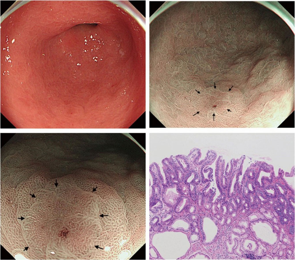 Image: LM-NBI detected diminutive lesion (Photo courtesy of Gastroenterology & Endoscopy)