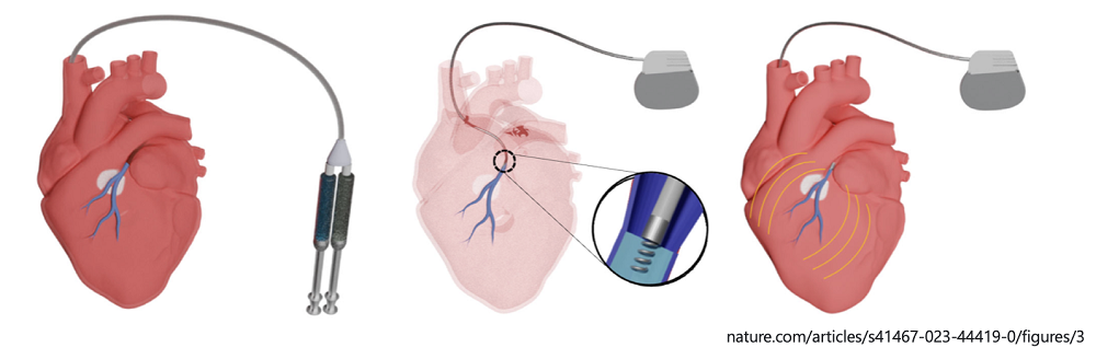 Image: The innovative hydrogel technology was deployed through minimally invasive catheter delivery in a pig model (Photo courtesy of Nature)
