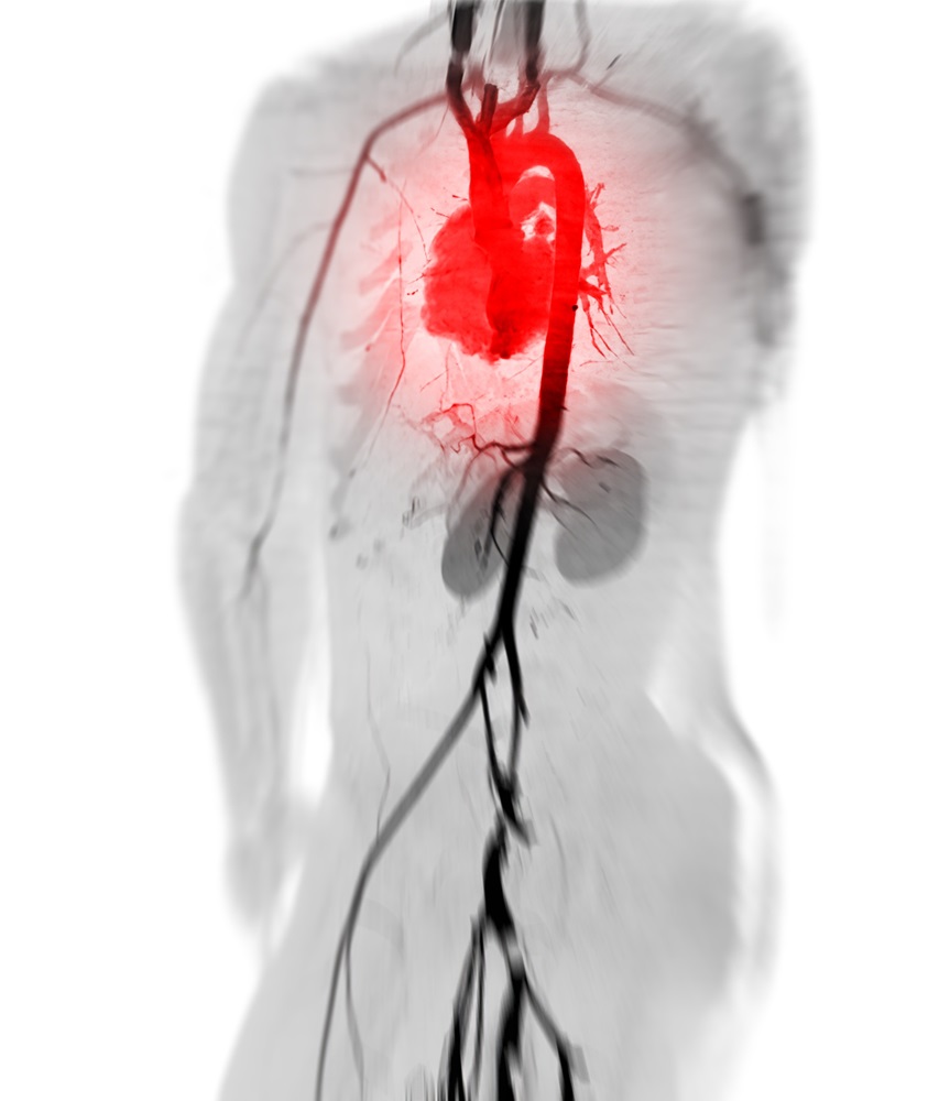 Image: Using patients’ own blood rather than saline helps preserve veins in coronary bypass grafts (Photo courtesy of 123RF)