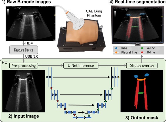 Image: Workflow diagram showing real-time lung ultrasound segmentation with U-Net (Photo courtesy of Ultrasonics) Image: Workflow diagram showing real-time lung ultrasound segmentation with U-Net (Photo courtesy of Ultrasonics)
