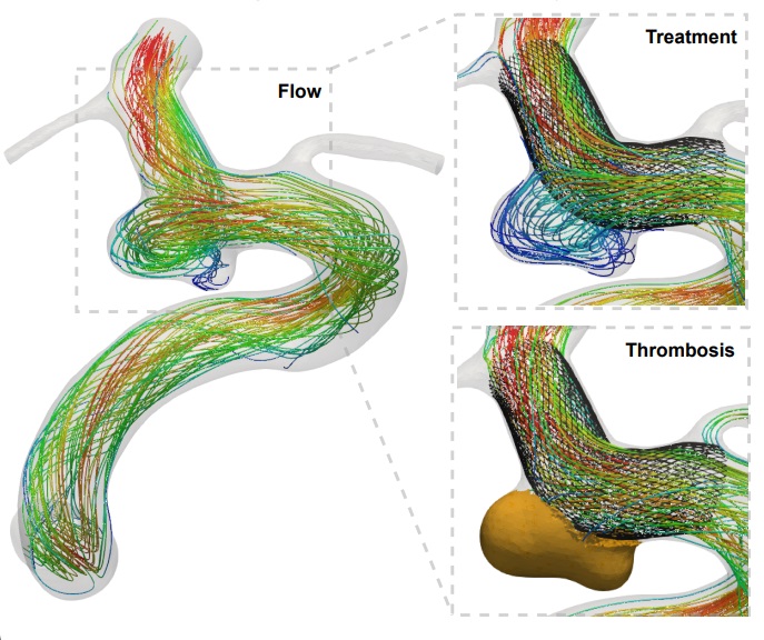 Image: Vascular flow modeling exemplar; intracranial aneurysm flow, treatment and thrombosis (Photo courtesy of University of Leeds)