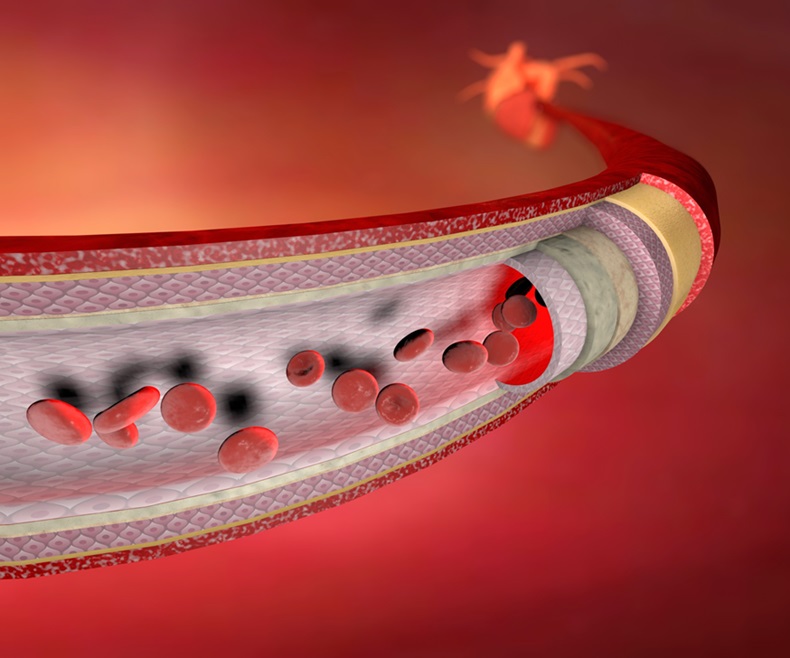 Image: Patients treated with a balloon coated with paclitaxel were found to have lower rates of failure (Photo courtesy of 123RF)