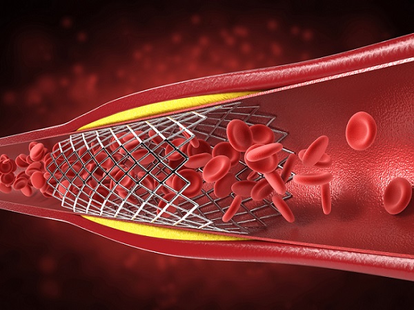 Image: Preventive percutaneous coronary intervention for high-risk coronary plaques shows substantial benefits over medications alone (Photo courtesy of Shutterstock)