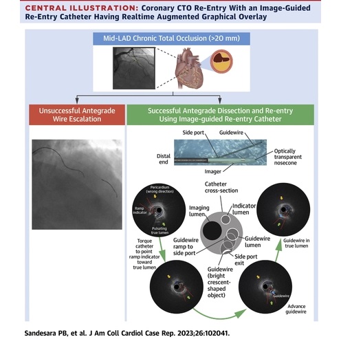 Image: Coronary CTO re-entry with an image-guided reentry catheter having real time augmented graphical overlay (Photo courtesy of JACC Journals)