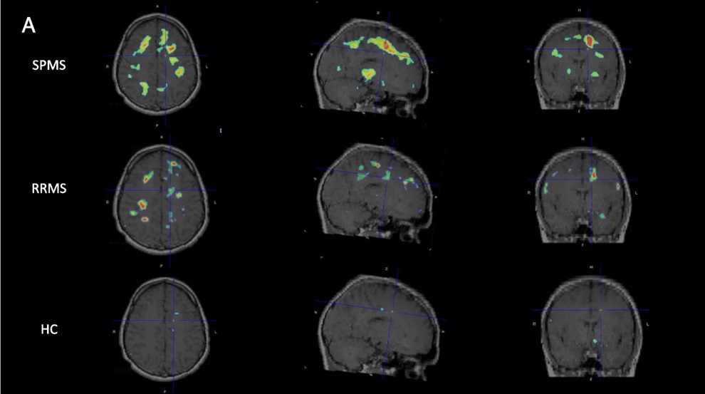 Individualized parametric z-score maps of the brain showing glial activity load on PET (GALP) in the brain, compared among secondary progressive MS (SPMS, top row), relapsing remitting MS (RRMS, middle row), and healthy controls (HC, bottom row) in transaxial, sagittal, and coronal sections (Photo courtesty of Singhal et al., Clinical Nuclear Medicine 2024) Individualized parametric z-score maps of the brain showing glial activity load on PET (GALP) in the brain, compared among secondary progressive MS (SPMS, top row), relapsing remitting MS (RRMS, middle row), and healthy controls (HC, bottom row) in transaxial, sagittal, and coronal sections (Photo courtesty of Singhal et al., Clinical Nuclear Medicine 2024)