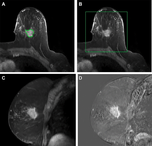 Image: The new AI tool to detect possible metastatic breast cancer could eliminate unnecessary biopsies (Photo courtesy of Polat, et al.; doi.org/10.1148/rycan.230107) Image: The new AI tool to detect possible metastatic breast cancer could eliminate unnecessary biopsies (Photo courtesy of Polat, et al.; doi.org/10.1148/rycan.230107)