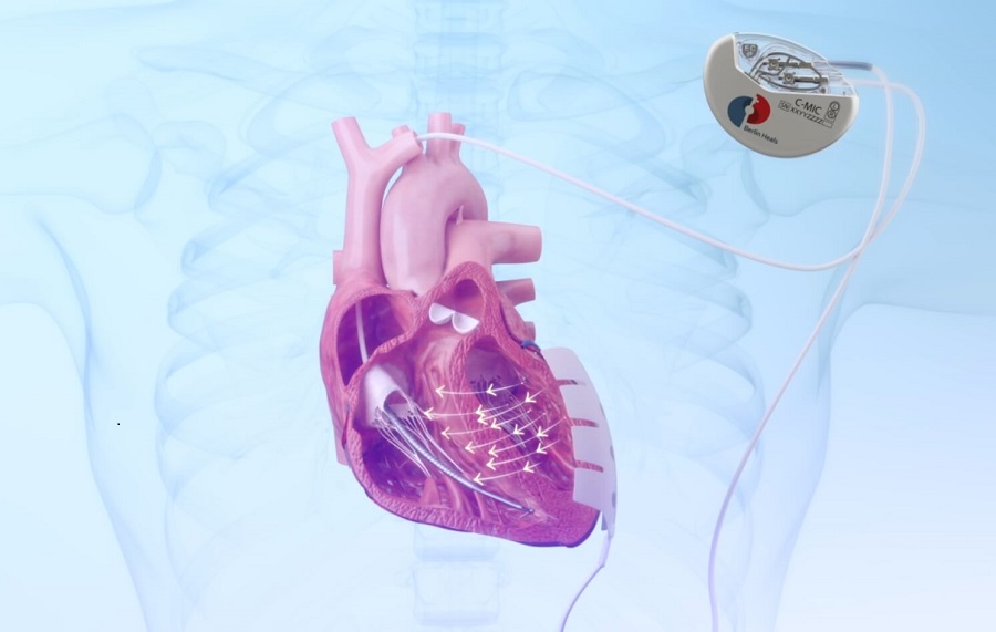 Image: The C-MIC device is a novel cardiac implant that redefines heart failure therapy (Photo courtesy of Berlin Heals)