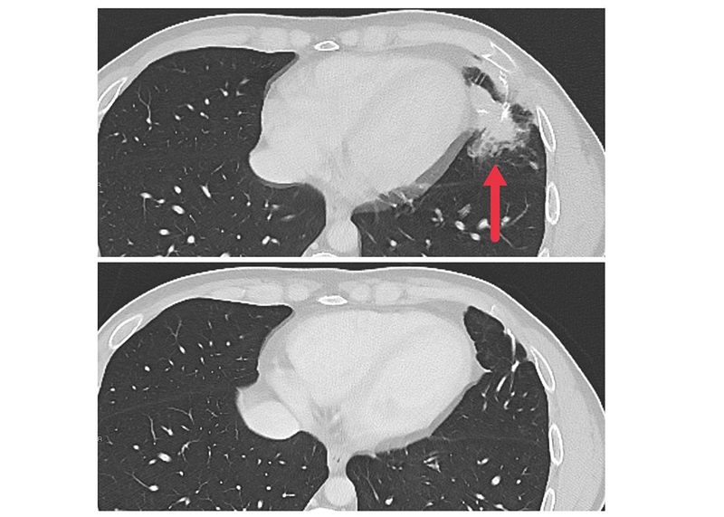 Image: Cross-sectional CT images showing a metastatic tumor in the left lung of a patient (top image) and no tumor following treatment (bottom image) (Photo courtesy of NIH)