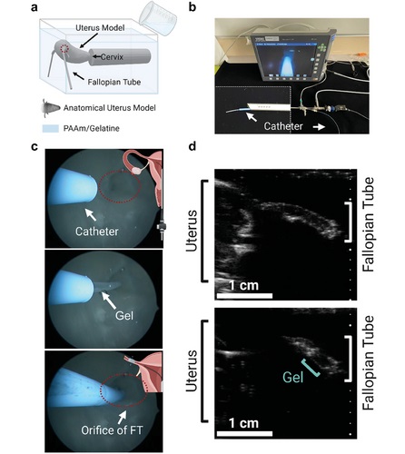 Image: Surgical application of the hydrogel system in a human-scale uterus model. (Photo courtesy of Advanced Materials)
