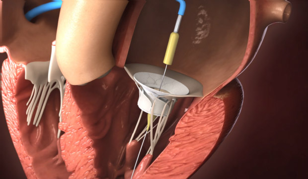 Image: The Innovalve transseptal delivery system is designed to enable safe deployment of the Innovalve implant (Photo courtesy of Innovalve Bio)