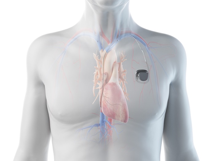Image: A new study has found lasting, reliable performance for wireless pacemakers (Photo courtesy of 123RF)