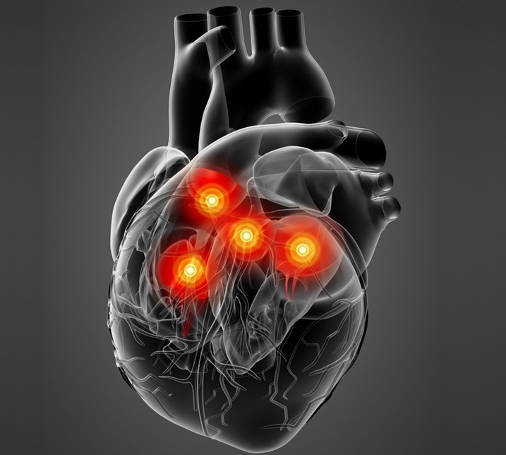 Image: Researchers are using AI to pick up early signs of mitral valve regurgitation, the most common heart valve disorder (Photo courtesy of 123RF)