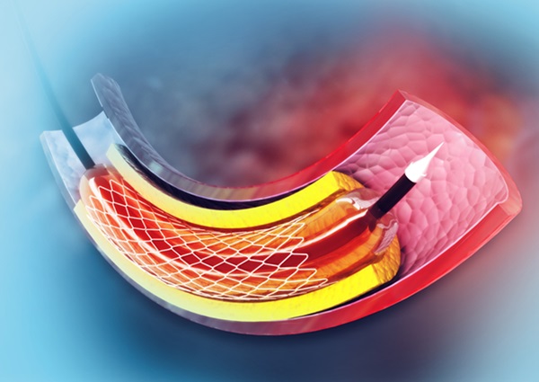 Image: Drug-coated balloon angioplasty has been found less effective than second generation drug-eluting stents for previously untreated non-complex coronary lesions (Photo courtesy of 123RF)