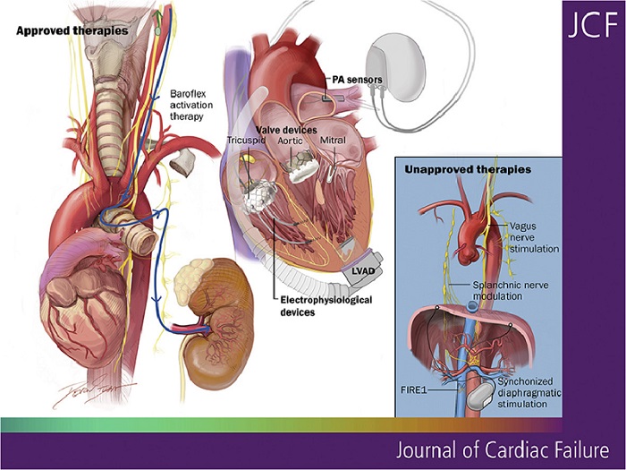 Image: The HFSA scientific statement provides an overview and update of the rapidly evolving field of device-based therapies for heart failure (Photo courtesy of JCF)