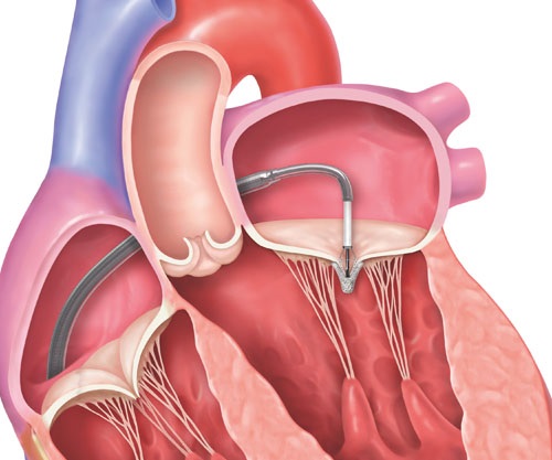 Image: Mitral valve repair via catheter offered significant benefit even in patients with moderate mitral regurgitation (Photo courtesy of Abbott)