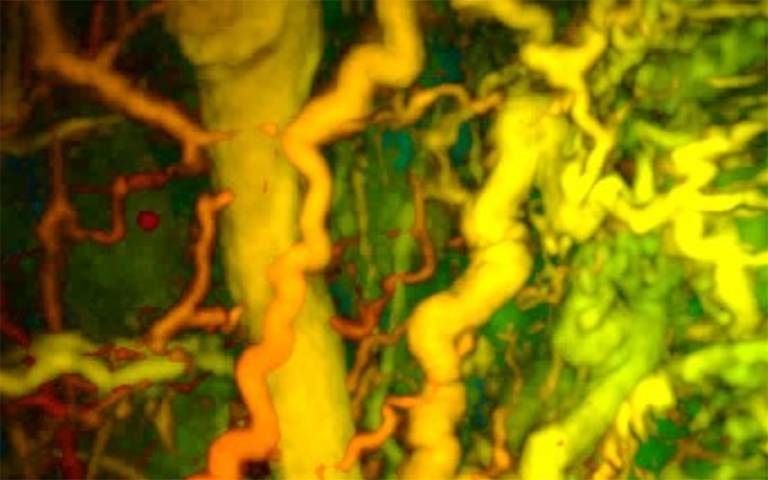 Image: Disease captured by the hand-held 3D photoacoustic scanner (Photo courtesy of Dr. Nam Huynh) Image: Disease captured by the hand-held 3D photoacoustic scanner (Photo courtesy of Dr. Nam Huynh)