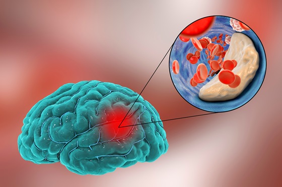 Image: The deep-learning model will predict clinical outcomes in stroke patients treated with clot-busting medications and/or endovascular therapy treatment (Photo courtesy of 123RF)