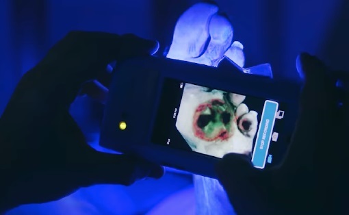 Image: The MolecuLight i:X is a class II FDA-cleared POC imaging devices for real-time detection of elevated bacterial burden in wounds (Photo courtesy of MolecuLight)