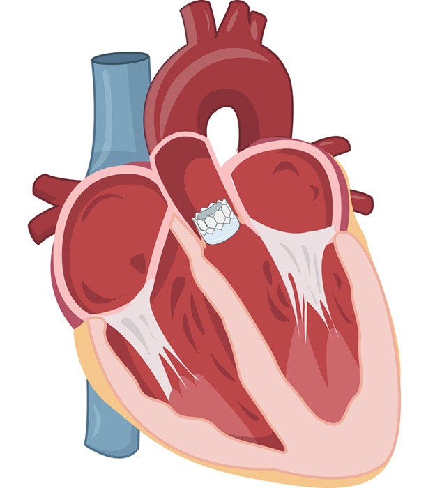 Image: A study has found early TAVR to be beneficial for patients with asymptomatic severe aortic stenosis (Photo courtesy of Shutterstock)