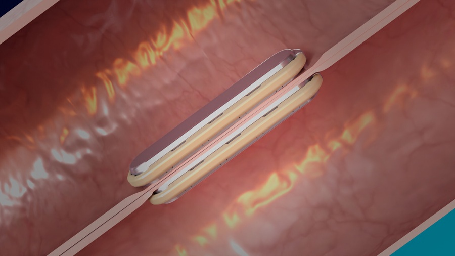 Image: Self-aligning MagDI System magnets fused together (Photo courtesy of GT Metabolic Solutions)