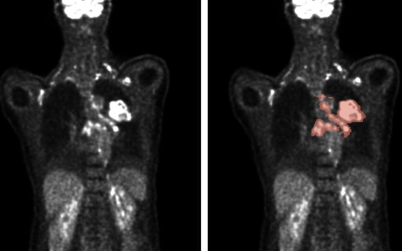 Image: Automated methods enable the analysis of PET/CT scans (left) to accurately predict tumor location and size (right) (Photo courtesy of Nature Machine Intelligence, 2024. DOI: 10.1038/s42256-024-00912-9) Image: Automated methods enable the analysis of PET/CT scans (left) to accurately predict tumor location and size (right) (Photo courtesy of Nature Machine Intelligence, 2024. DOI: 10.1038/s42256-024-00912-9)
