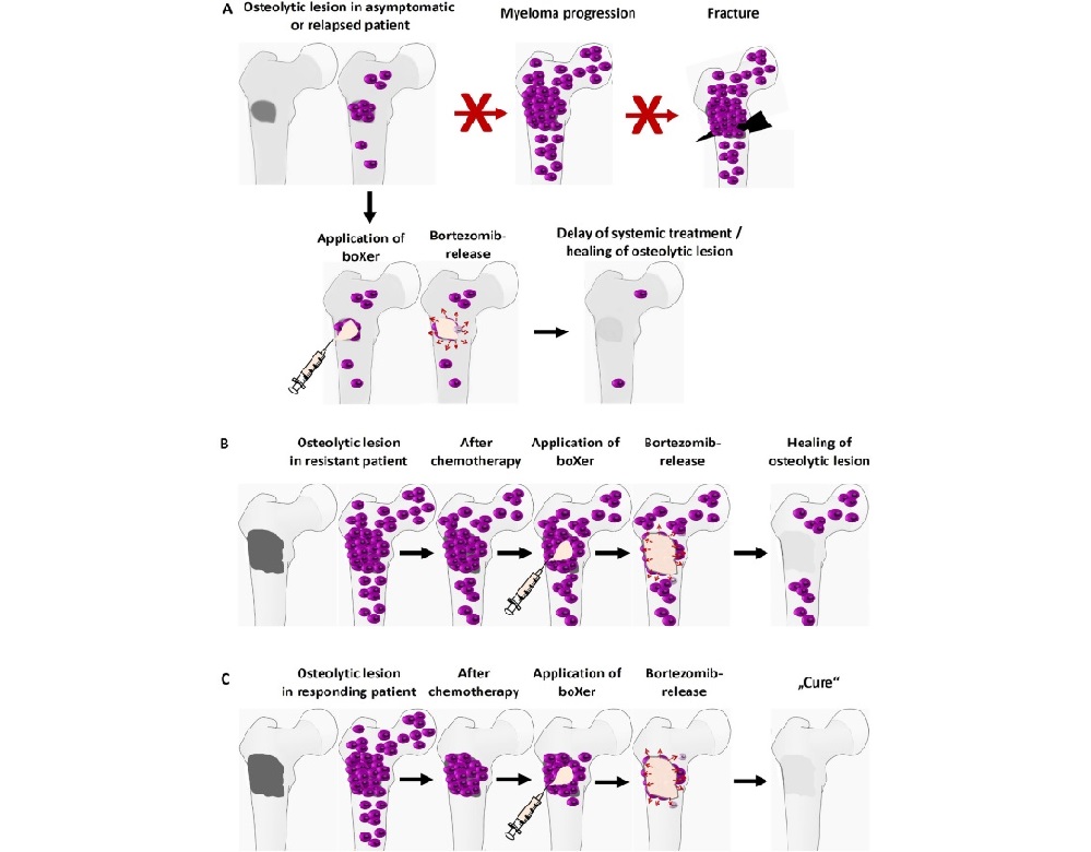 Image: Potential applications of sicXer and boXer in multiple myeloma treatment (Photo courtesy of Journal of Hematology & Oncology, DOI:10.1186/s13045-024-01636-4)