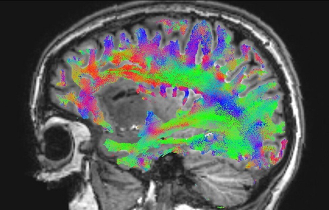 Image: White matter connections mapped in the MRI image of a patient’s glioma (Photo courtesy of Lars Smolders/TU/e)