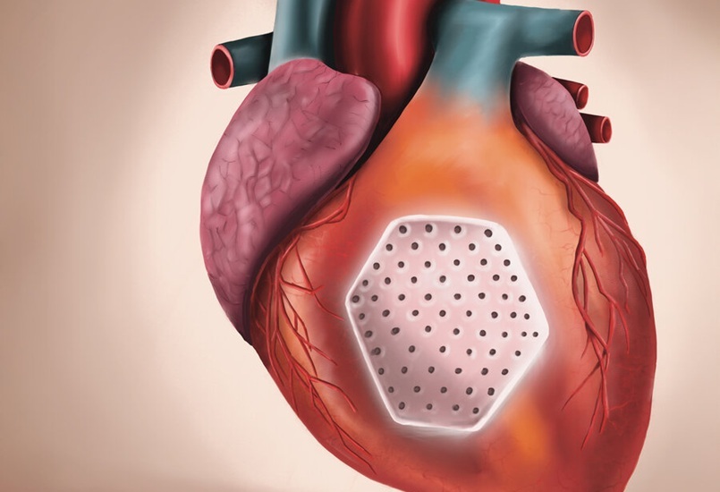 Image: The heart patch is produced from induced pluripotent stem cells derived heart muscle cells in a collagen hydrogel (Photo courtesy of UMG/Eva Meyer-Besting)