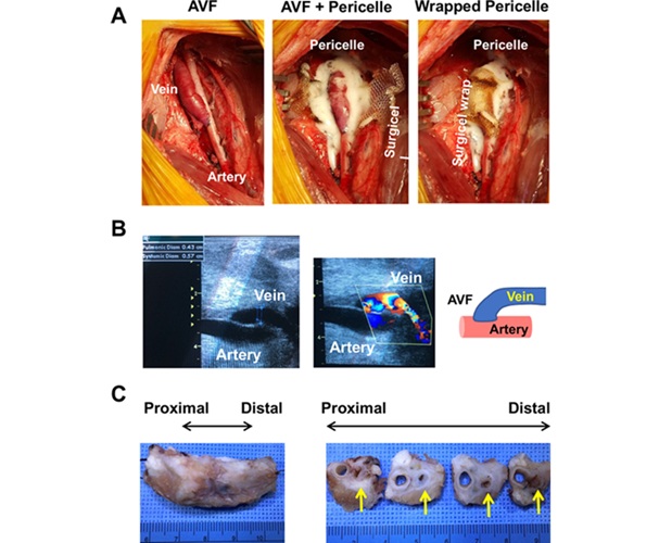 Image: Application of Pericelle to the porcine model of femoral arterio-venous fistula (Bioactive Materials, DOI:10.1016/j.bioactmat.2024.10.005)