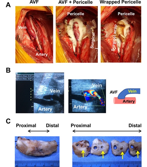 Image: Application of Pericelle to the porcine model of femoral arterio-venous fistula (Photo courtesy of Bioactive Materials, DOI:10.1016/j.bioactmat.2024.10.005)