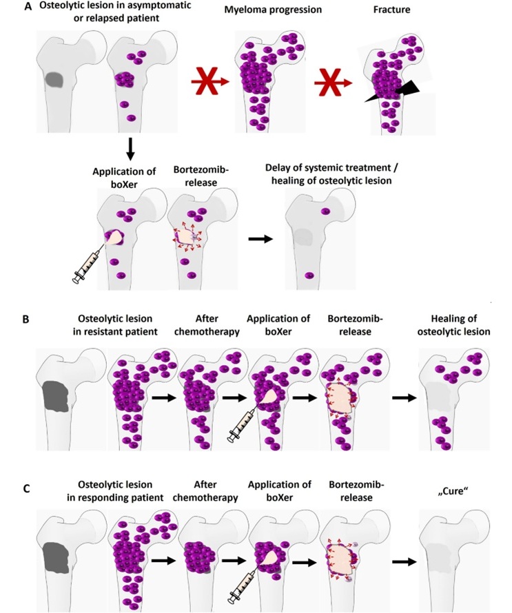 Image: Potential applications of sicXer and boXer in multiple myeloma treatment (Photo courtesy of Journal of Hematology & Oncology, DOI:10.1186/s13045-024-01636-4)