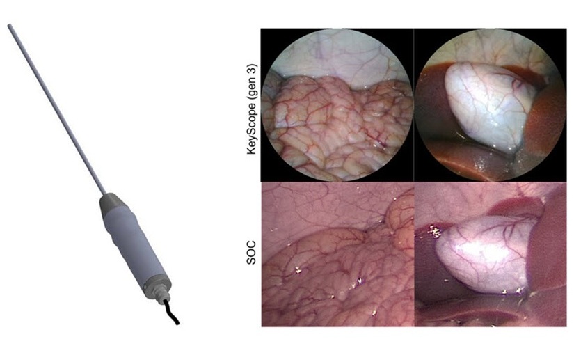 Image: The KeyScope low-cost laparoscope enables high resolution surgical imaging (Photo courtesy of Barnes et al., doi 10.1117/1.BIOS.2.2.022302)