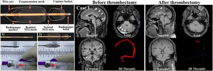 Image: Demonstration of Venus-TD and thrombectomy process in CVST patient (Photo courtesy of Capital Medical University)