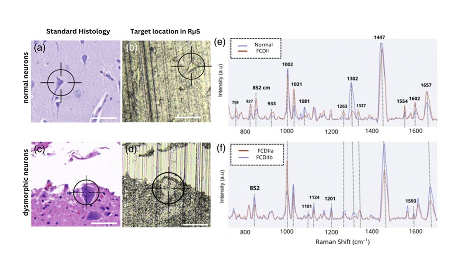 Image: Raman spectroscopy distinguishes normal brain tissue from dysplastic tissue in single-cell analysis (Photo courtesy of T. Tran et al., doi: 10.1117/1.BIOS.2.1.015002)