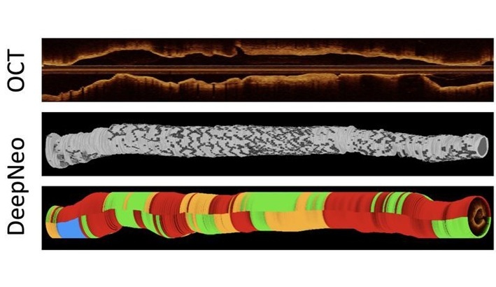 Image: The AI algorithm automates the process of analyzing coronary stents after implantation with medical expert accuracy (Photo courtesy of Helmholtz Munich)