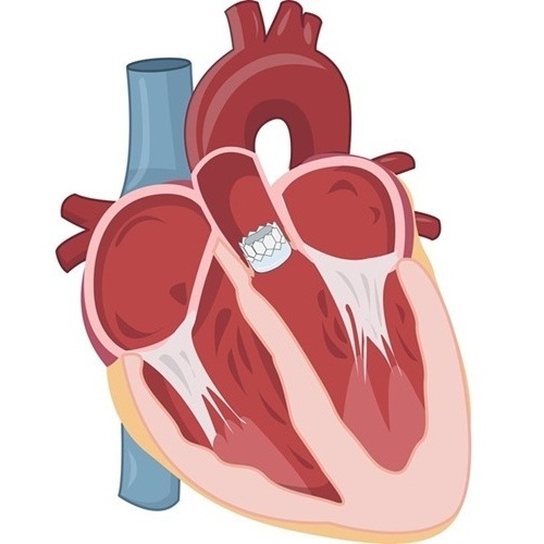 Image: Younger patients with asymptomatic AS who undergo TAVR experience lower rates of serious cardiovascular events (Photo courtesy of Shutterstock)