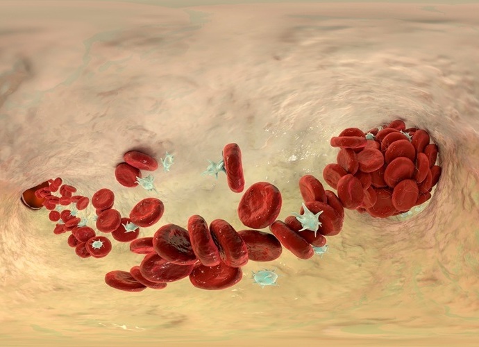Image: Reducing or blocking the protein that causes blood clot breakdown does not increase the formation of dangerous clots (Photo courtesy of 123RF)