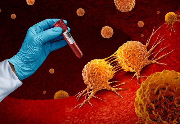 Image: Switching to an experimental drug after liquid biopsy detection of breast cancer recurrence can improve outcomes (Photo courtesy of Shutterstock) Image: Switching to an experimental drug after liquid biopsy detection of breast cancer recurrence can improve outcomes (Photo courtesy of Shutterstock)