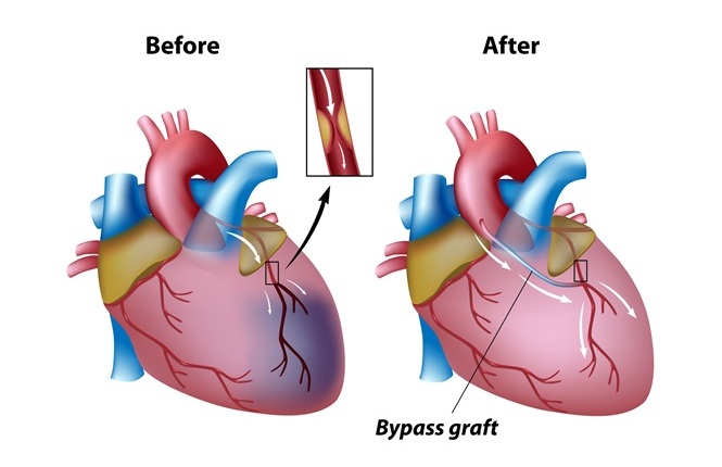 Image: Surgical ablation could improve survival in patients with preexisting atrial fibrillation undergoing CABG (Photo courtesy of 123RF)