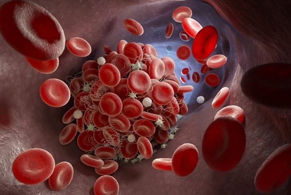 Image: A nomogram predicts the risk of patients with epithelial ovarian cancer developing deep vein thrombosis (Photo courtesy of 123RF)