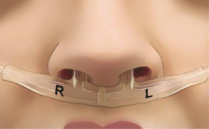 Image: Tubes beneath the nose measured airflow from each nostril, revealing each person’s unique breathing fingerprint (Photo courtesy of Soroka et al., Current Biology)