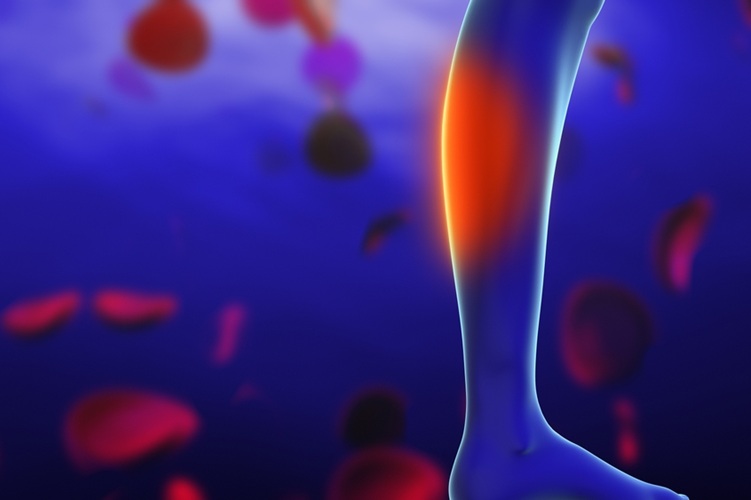 Image: New clinical guidance suggests treatments to prevent blood clots in CLTI patients after leg artery procedures (Photo courtesy of Shutterstock)