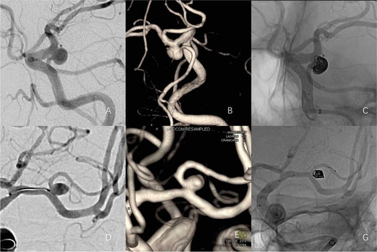 Image: A-C: The left embryonic posterior cerebral artery originates from the aneurysm neck. D-G: Left middle cerebral artery bifurcation aneurysm (Xiao, J., Li, T., Wan, D. et al. Chin Neurosurg Jl (2025). doi.org/10.1186/s41016-025-00390-x)