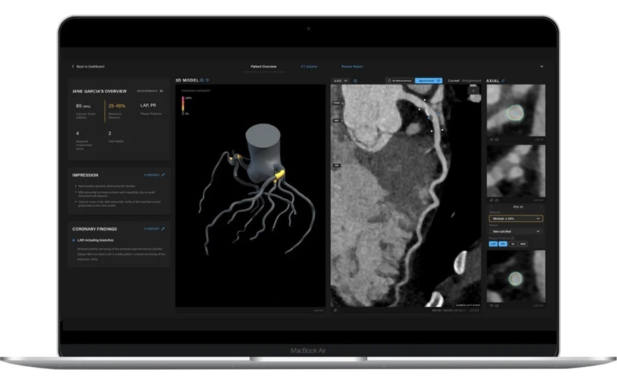 Image: The fully automated AI algorithm is more effective than current methods at predicting the risk of heart attack (Photo courtesy of Artrya Ltd.)