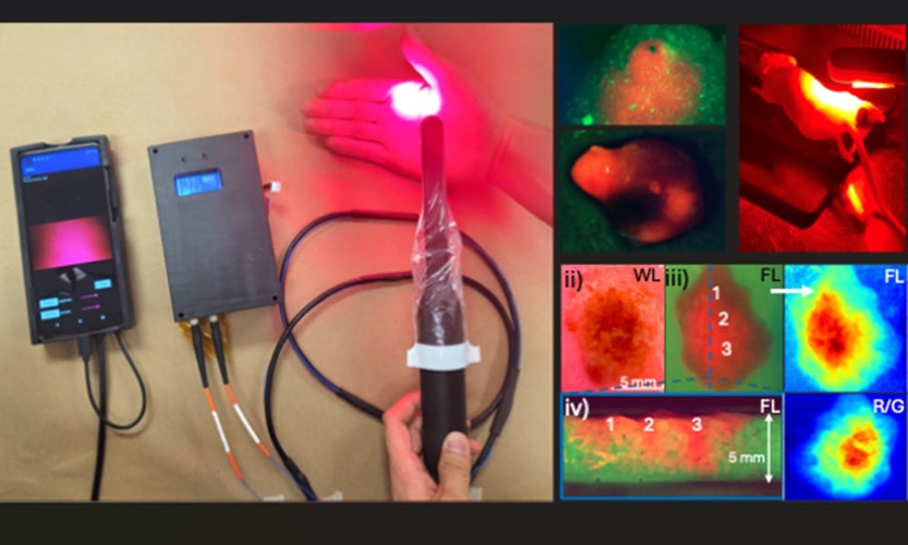 Image: The handheld tool uses fluorescence imaging to identify lesions and delivers targeted light therapy to destroy cancerous tissue (Photo courtesy of Khan et al., DOI: 10.1117/1.BIOS.2.4.042305)