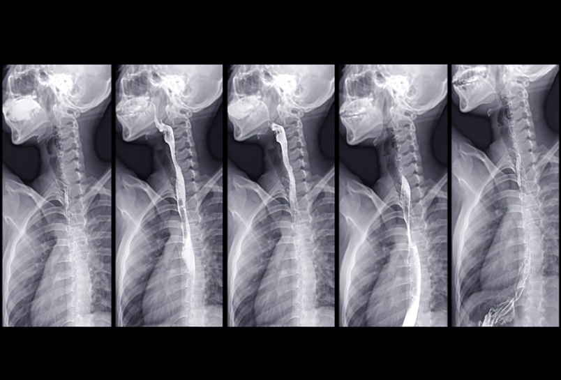 Image: A timed barium esophagram is a specialized X-ray test used to evaluate esophageal motor disorders (Photo courtesy of Adobe Stock)