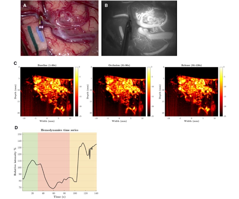Image: Intraoperative cerebral perfusion monitoring with ultrafast power doppler imaging (Niknejad et al., Sci Rep, 2025. doi.org/10.1038/s41598-025-04338-0)